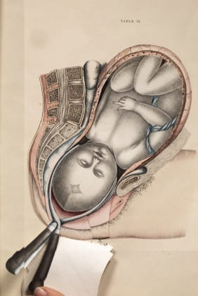 Obstetric Tables 7: forceps