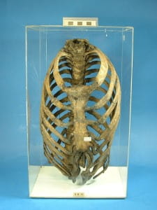 A deformed ribcage from the Hunterian Museum