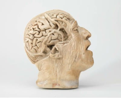 D.J. Cunningham and H Casciani, head of a 75-year old man. Plaster, before 1892. Hunterian Museum at the Royal College of Surgeons RCSHM/D 713