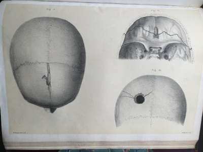 Sir Jonathan Hutchinson - Illustrations of Clinical Surgery (2)