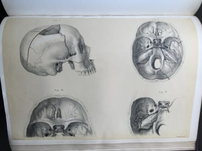 Sir Jonathan Hutchinson - Illustrations of Clinical Surgery (3)