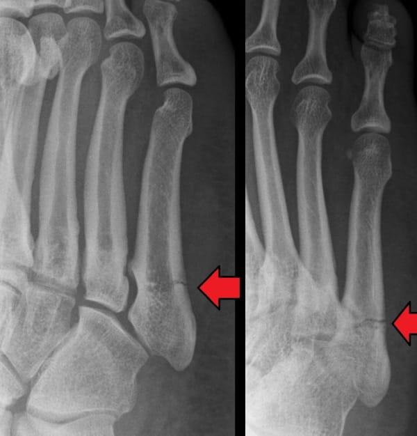 Sir Robert Jones 2: the Jones fracture