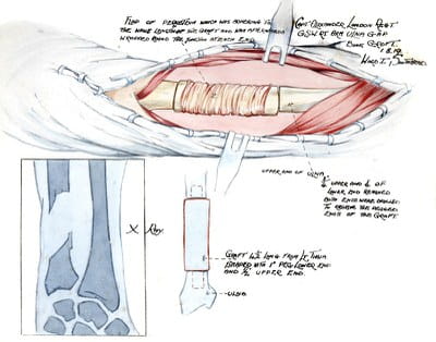 Artist Dulcie Pillars' diagram of a Hey Groves procedure, 1919. (From the Royal College of Surgeons Archives.)