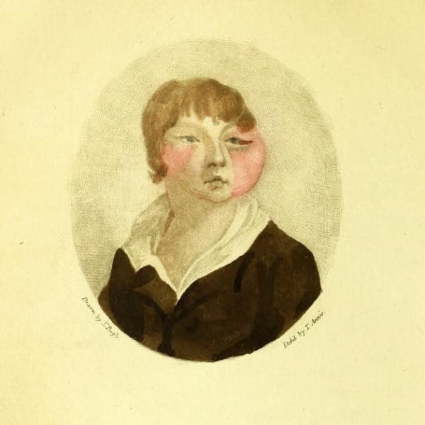 Boy with cow pox, from an anti-vaccination pamphlet by William Rowley, 1805